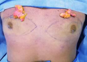 Gynecomastia Surgery Before & After Image