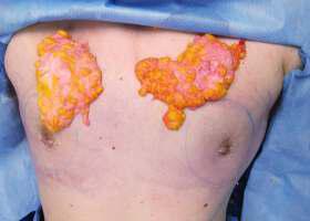 Gynecomastia Surgery Before & After Image