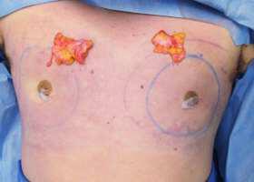 Gynecomastia Surgery Before & After Image