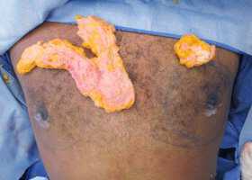 Gynecomastia Surgery Before & After Image