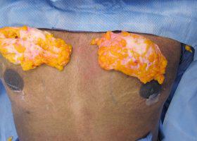 Gynecomastia Surgery Before & After Image