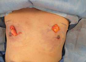 Gynecomastia Surgery Before & After Image