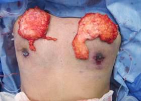 Gynecomastia Surgery Before & After Image