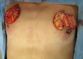Gynecomastia Surgery Before & After Image