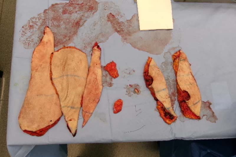 Gynecomastia Surgery Before & After Image