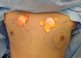 Gynecomastia Surgery Before & After Image