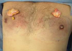 Gynecomastia Surgery Before & After Image