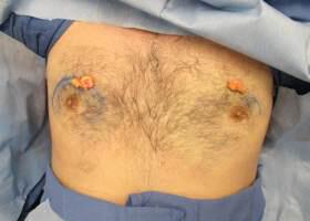 Gynecomastia Surgery Before & After Image