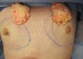 Gynecomastia Surgery Before & After Image