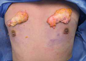Gynecomastia Surgery Before & After Image