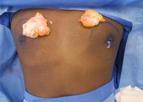 Gynecomastia Surgery Before & After Image