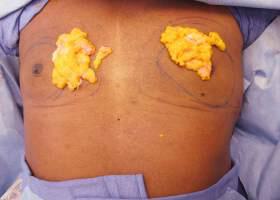 Gynecomastia Surgery Before & After Image