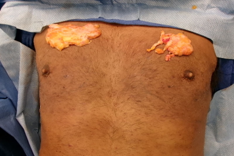 Gynecomastia Surgery Before & After Image