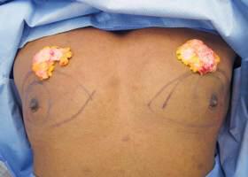 Gynecomastia Surgery Before & After Image