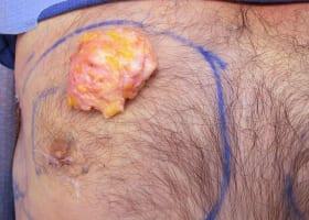 Gynecomastia Surgery Before & After Image