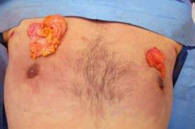 Gynecomastia Surgery Before & After Image