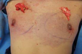 Gynecomastia Surgery Before & After Image