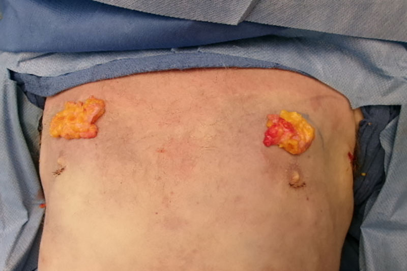 Gynecomastia Surgery Before & After Image