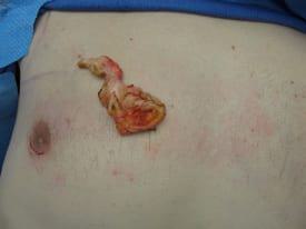 Gynecomastia Surgery Before & After Image