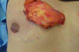 Gynecomastia Surgery Before & After Image