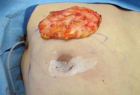 Gynecomastia Surgery Before & After Image