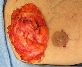 Gynecomastia Surgery Before & After Image