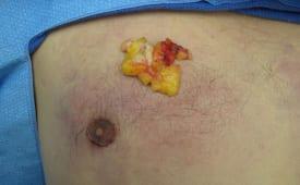 Gynecomastia Surgery Before & After Image