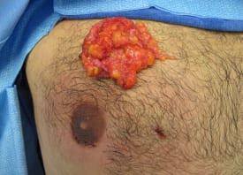 Gynecomastia Surgery Before & After Image