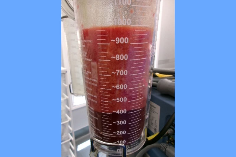 Gynecomastia Surgery Before & After Image