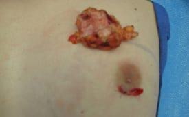 Gynecomastia Surgery Before & After Image