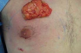 Gynecomastia Surgery Before & After Image