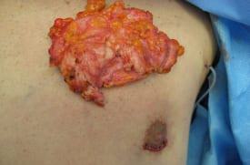 Gynecomastia Surgery Before & After Image