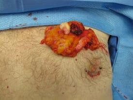 Gynecomastia Surgery Before & After Image