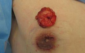 Gynecomastia Surgery Before & After Image