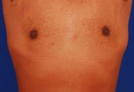Gynecomastia Surgery Before & After Image