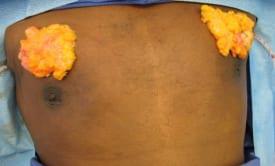 Gynecomastia Surgery Before & After Image