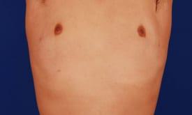 Gynecomastia Surgery Before & After Image