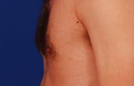 Gynecomastia Surgery Before & After Image