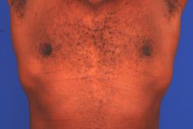 Gynecomastia Surgery Before & After Image