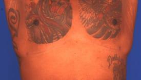 Gynecomastia Surgery Before & After Image