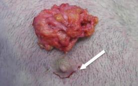 Gynecomastia Surgery Before & After Image