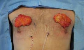 Gynecomastia Surgery Before & After Image