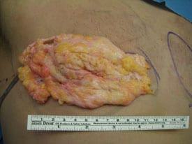 Gynecomastia Surgery Before & After Image