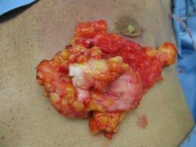 Gynecomastia Surgery Before & After Image