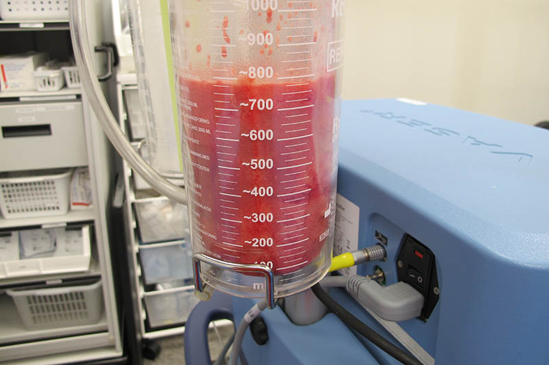 Revision Gynecomastia Surgery Before & After Image