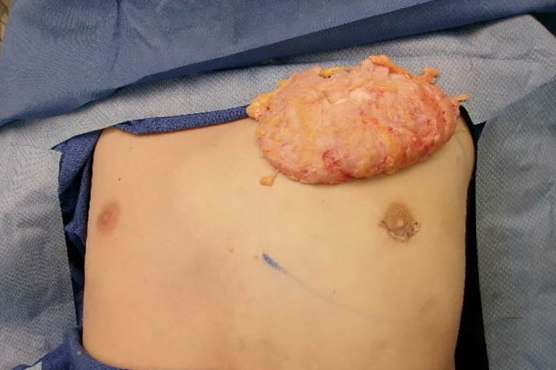 Gynecomastia Surgery Before & After Image