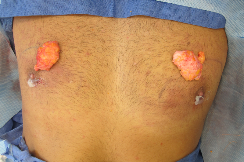 Gynecomastia Surgery Before & After Image