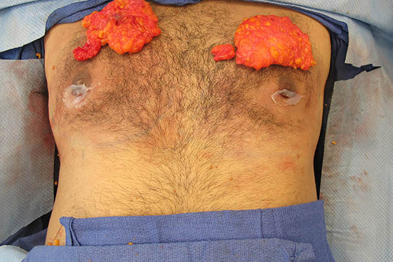 Gynecomastia Surgery Before & After Image