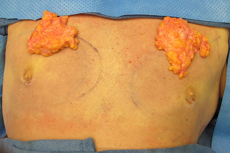 Gynecomastia Surgery Before & After Image