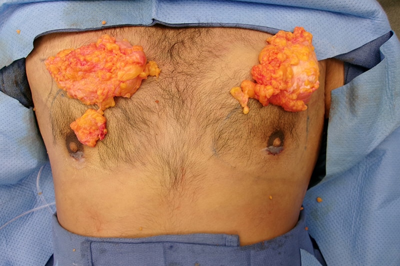 Gynecomastia Surgery Before & After Image